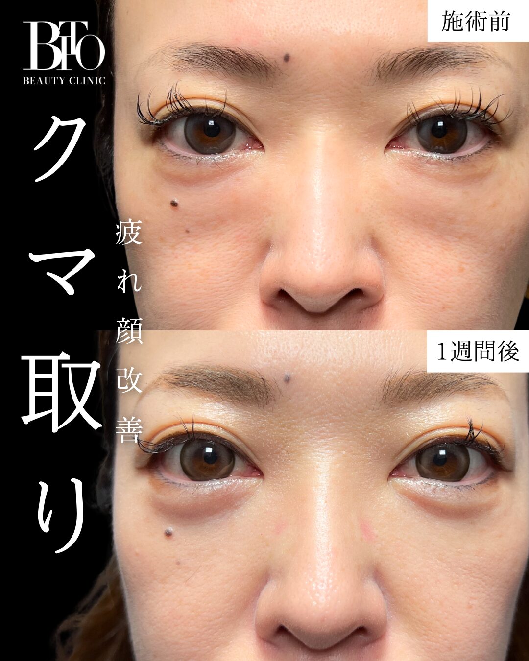 005.クマ取り | BITO BEAUTY CLINIC