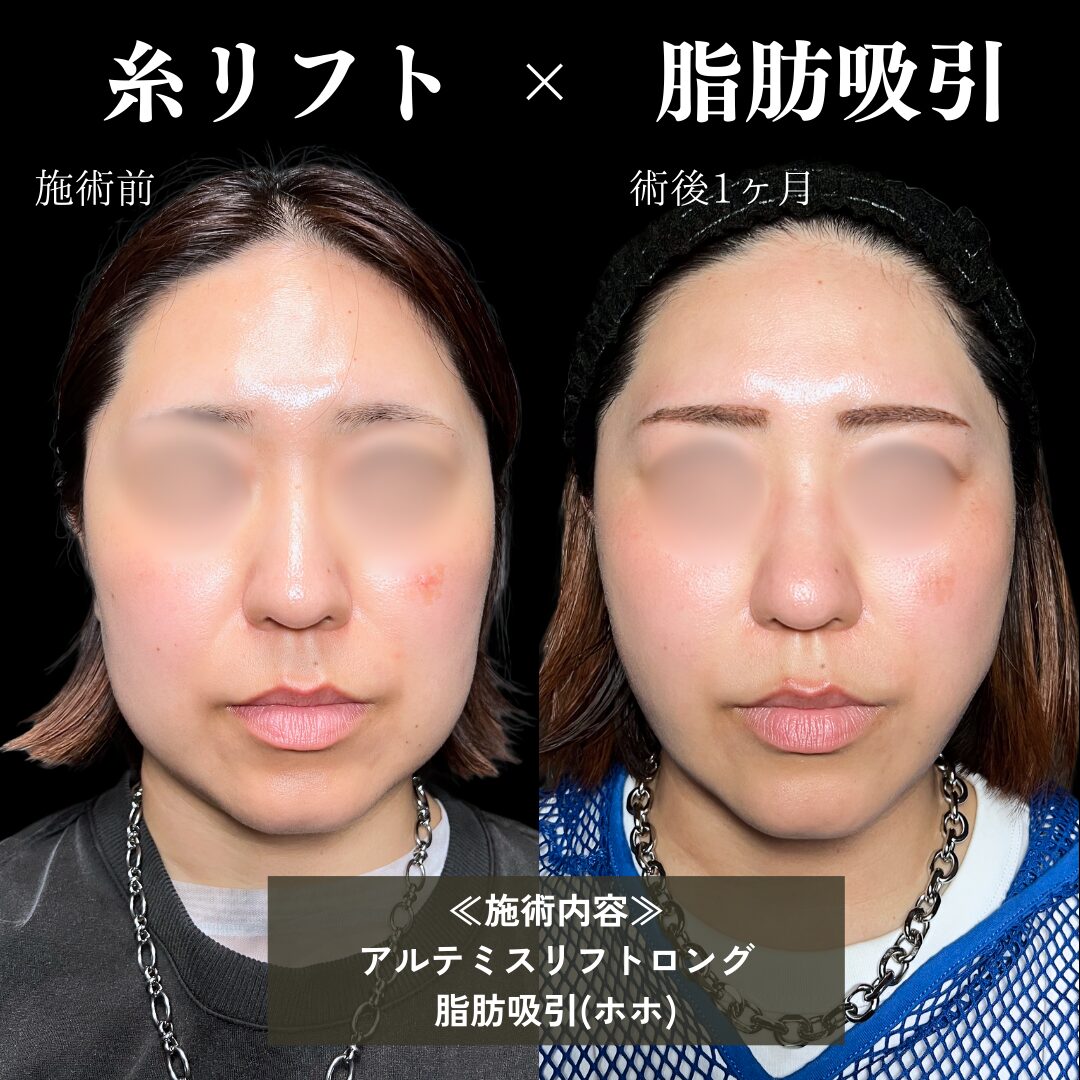 脂肪吸引