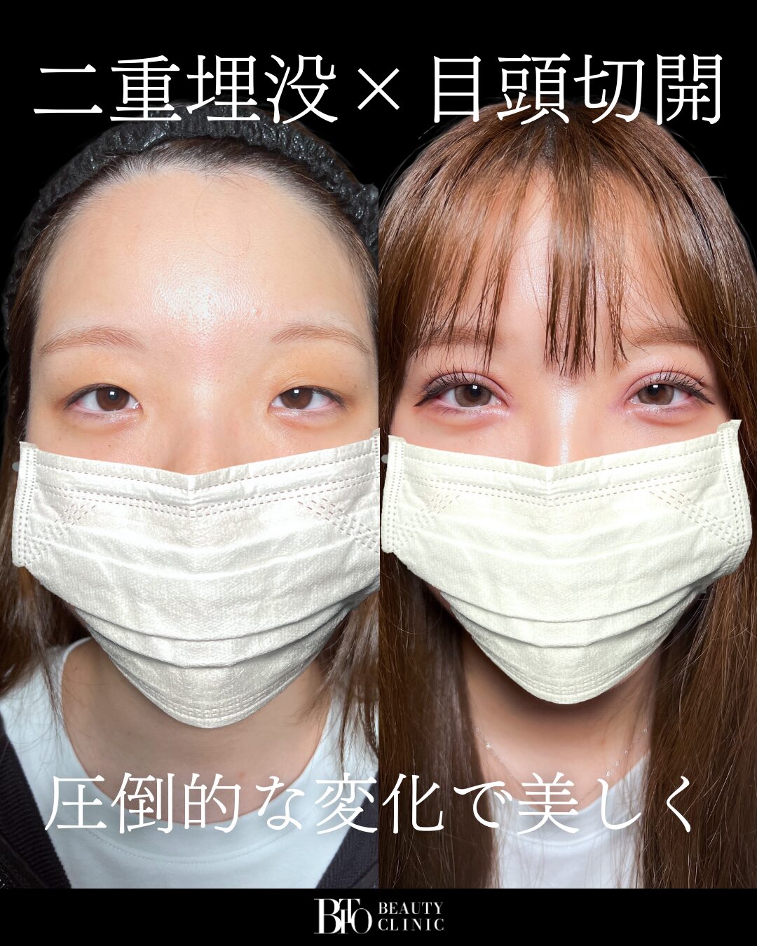 二重埋没法×目頭切開