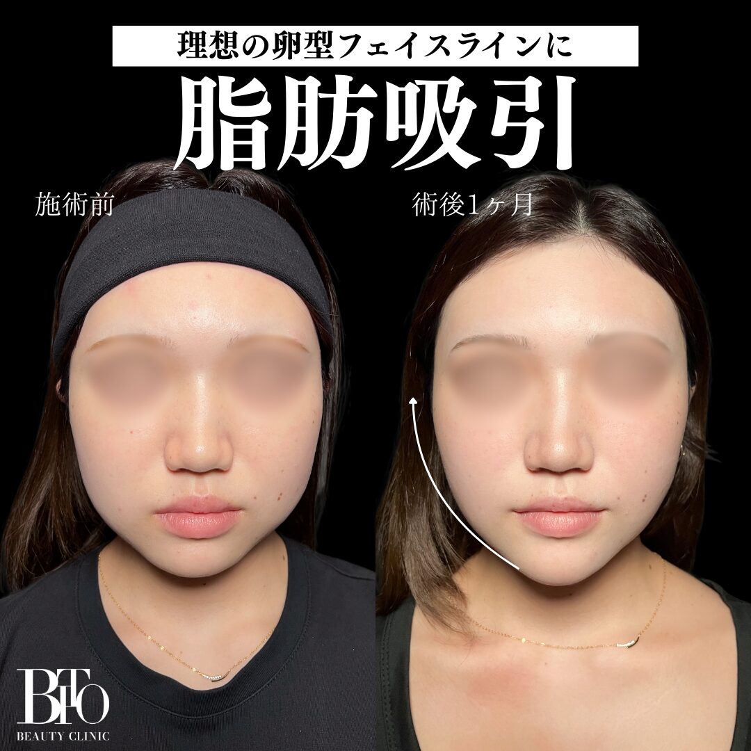 脂肪吸引