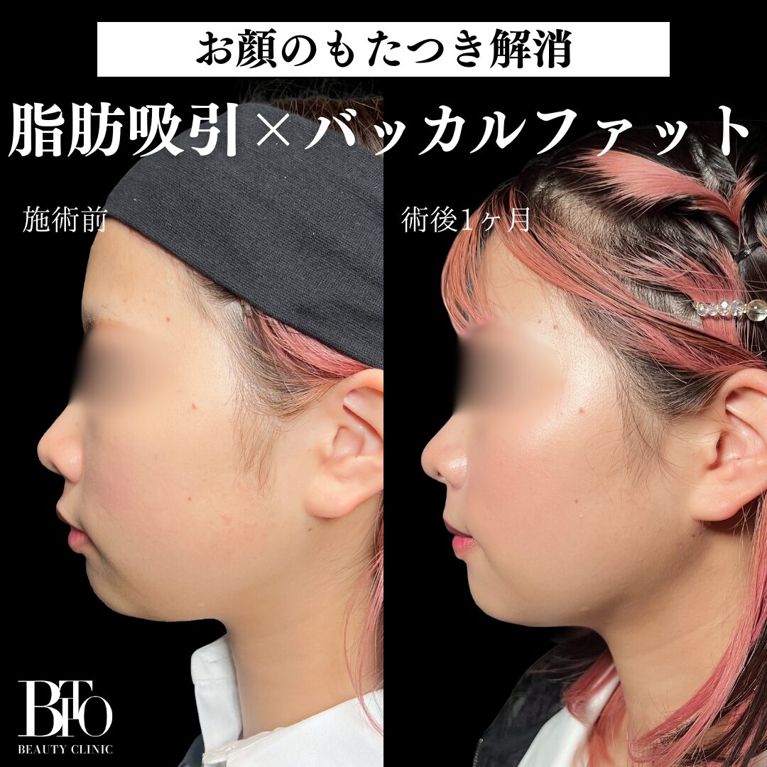 脂肪吸引