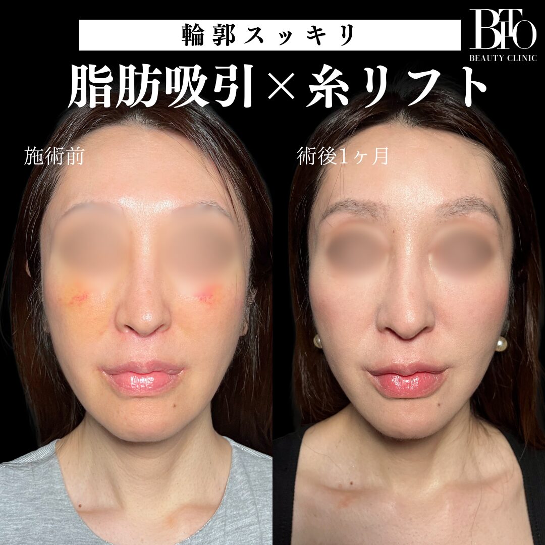 脂肪吸引