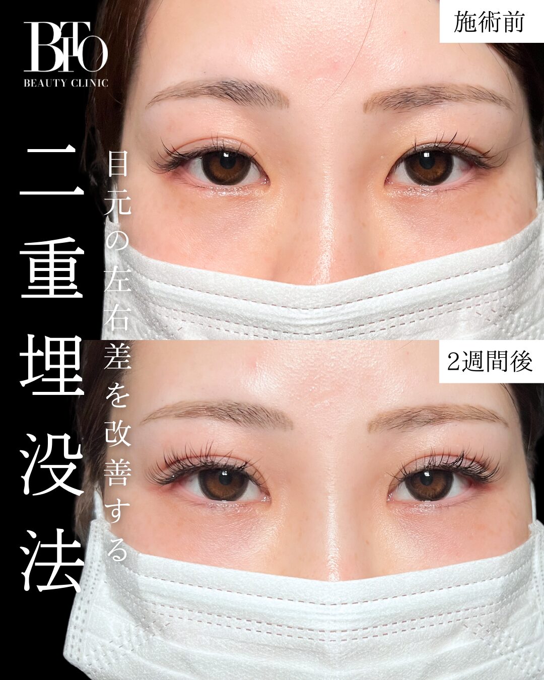 二重埋没法