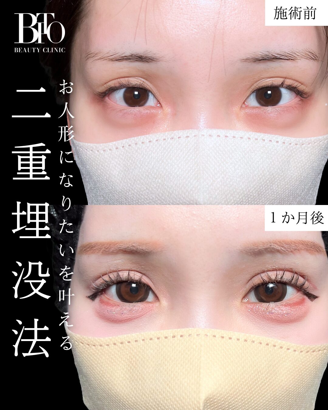 二重埋没法