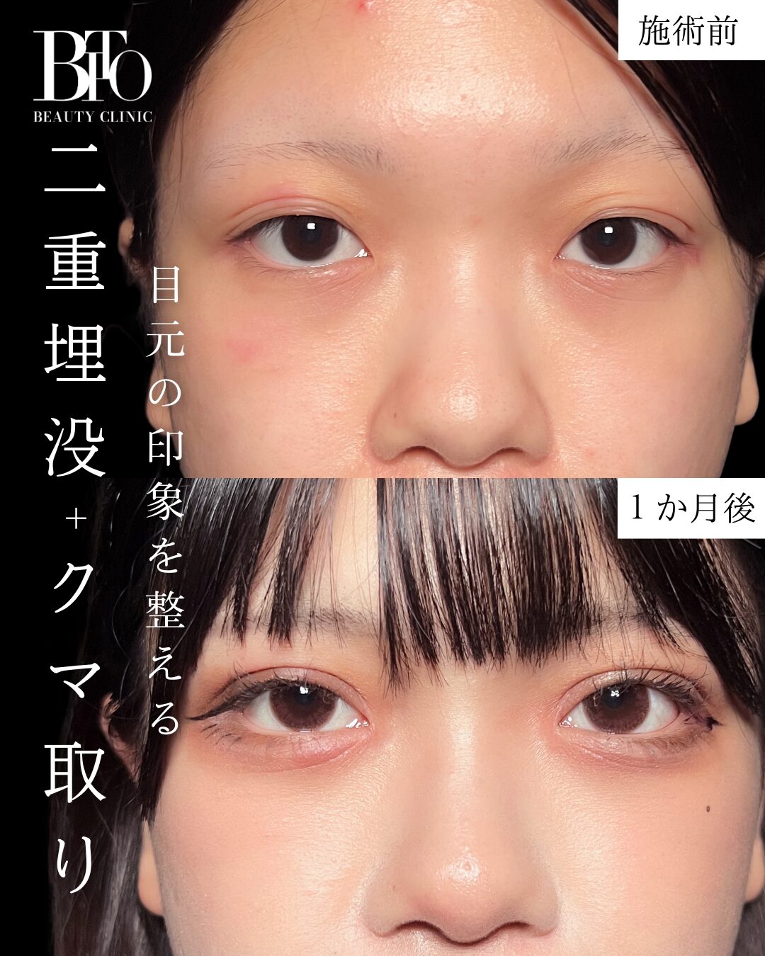 二重埋没法