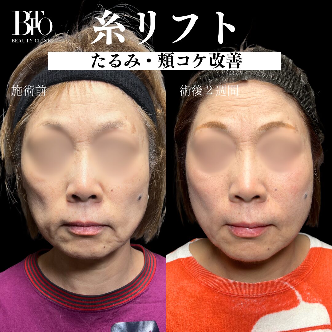 糸リフト