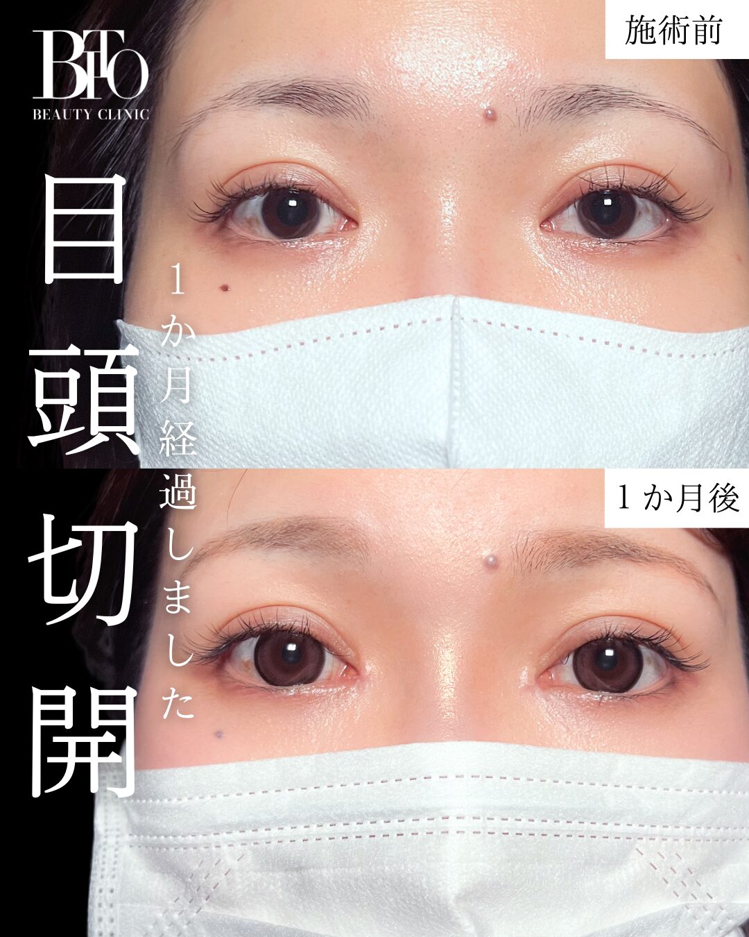 目頭切開