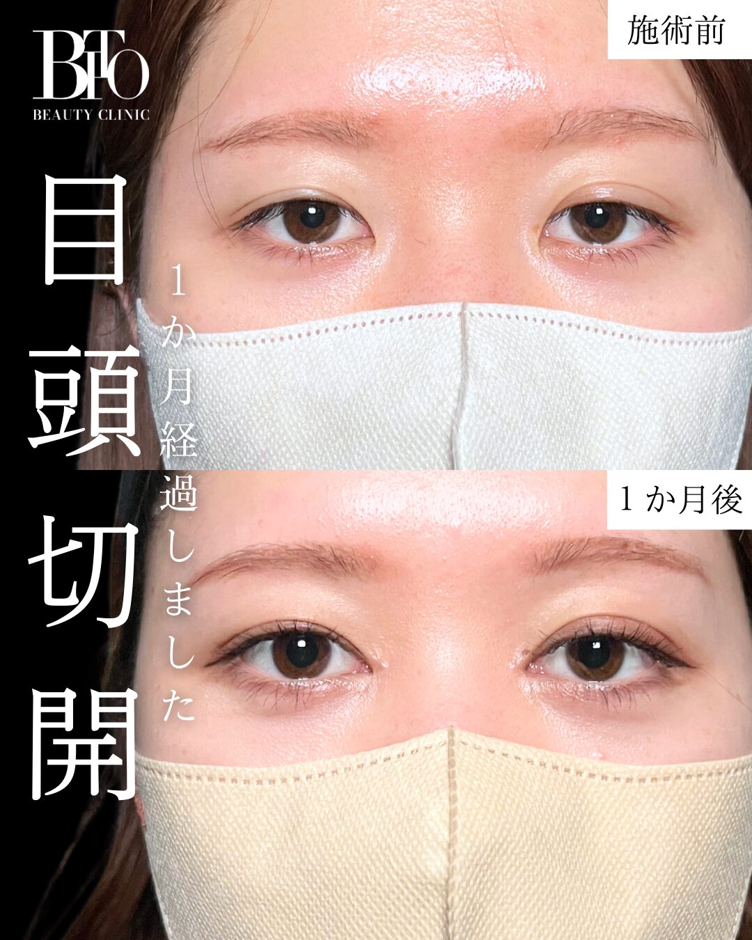 目頭切開