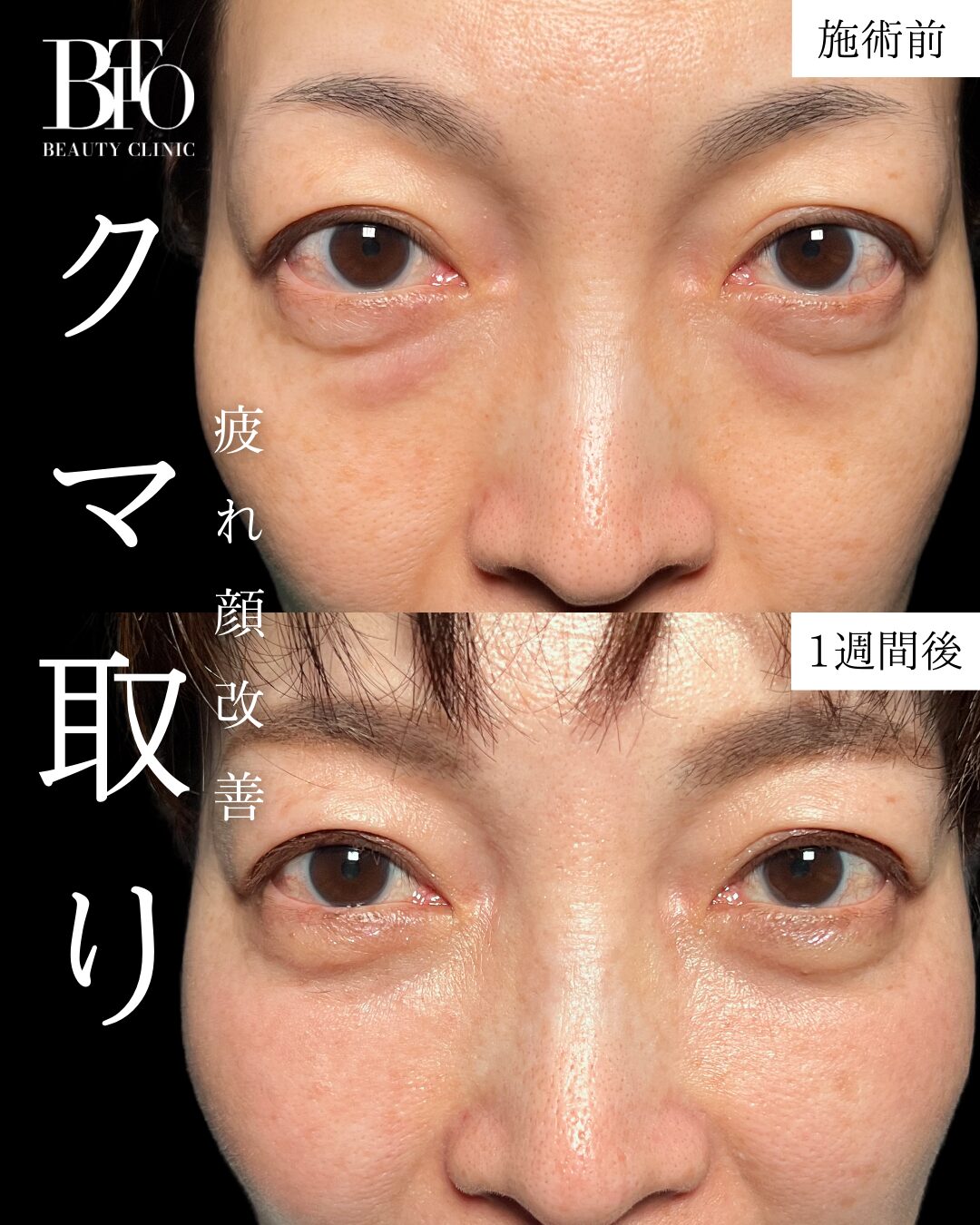 クマ取り