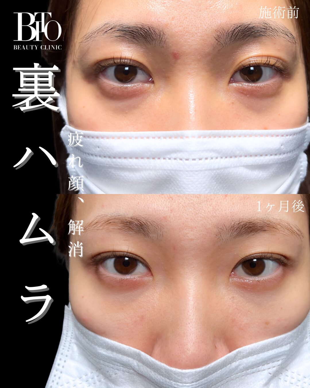 裏ハムラ法