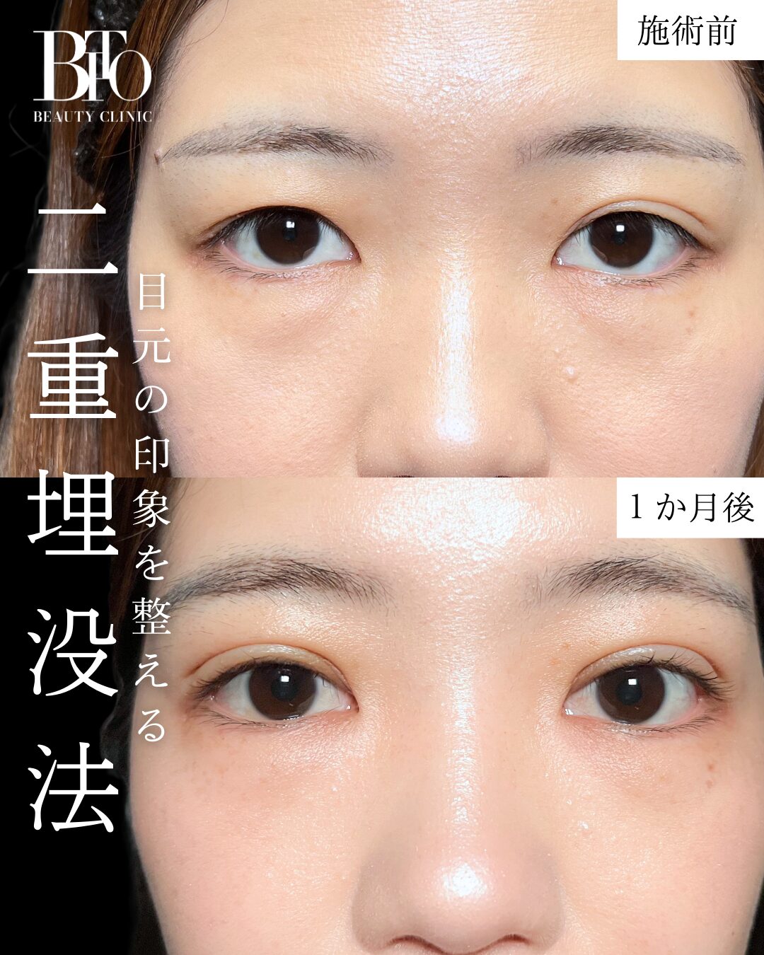 二重埋没法