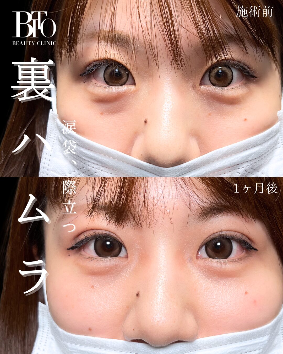 裏ハムラ法