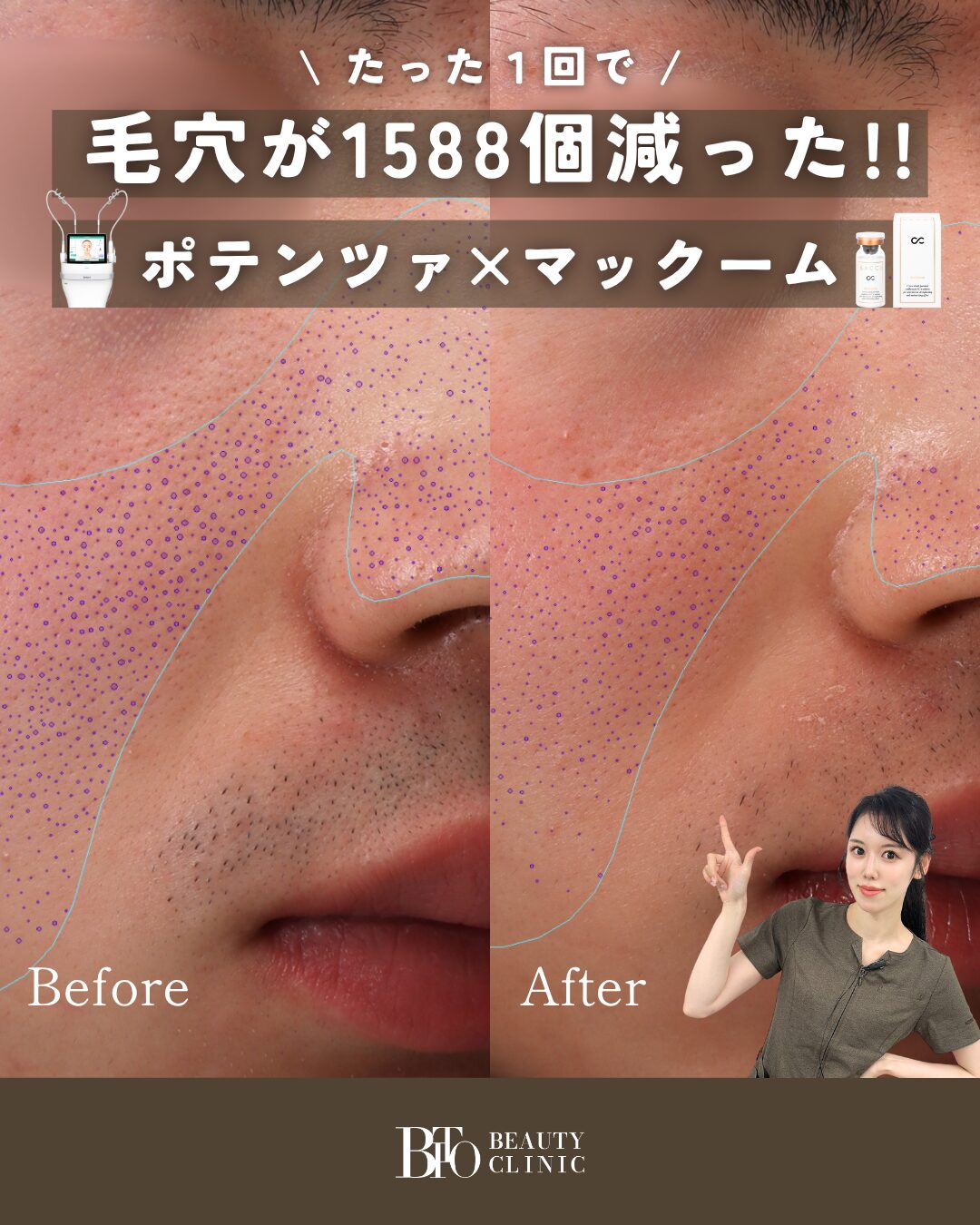 ポテンツァ（毛穴や肝斑など3種類のモードから選択）全顔※初診料込 東京でポテンツァが安いおすすめクリニック12選！費用相場も解説