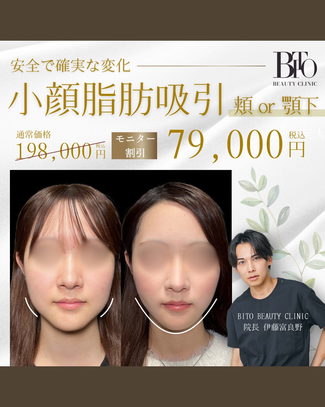 脂肪吸引 頬or顎下 ￥79,000