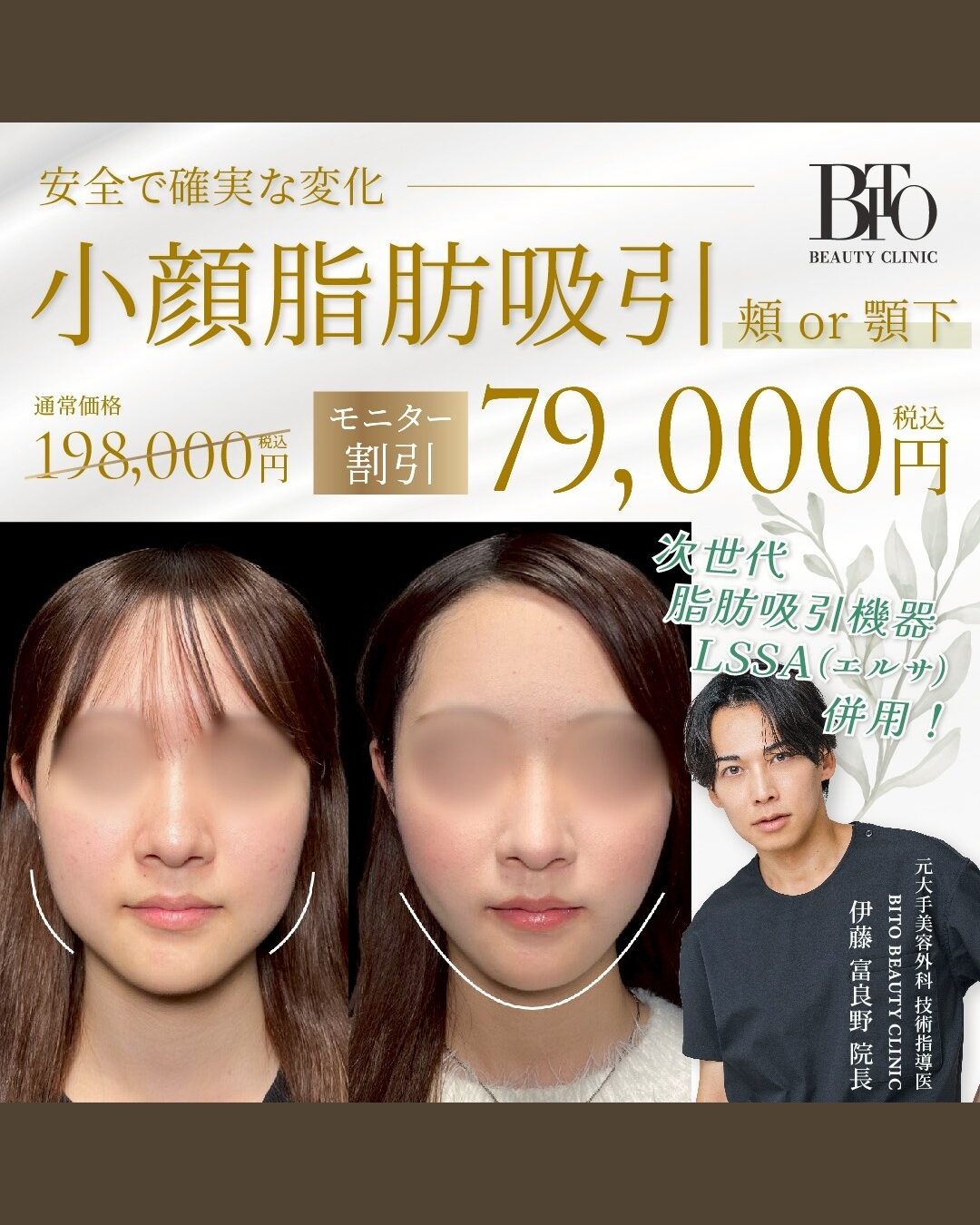 12月キャンペーン:LSSA脂肪吸引 頬or顎下 ￥79,000-