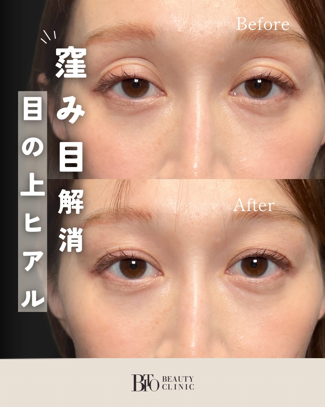 076.ヒアルロン酸