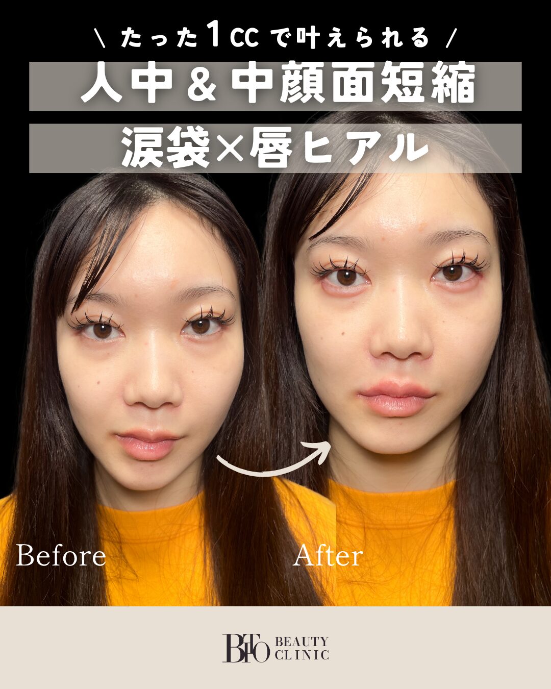 074.ヒアルロン酸