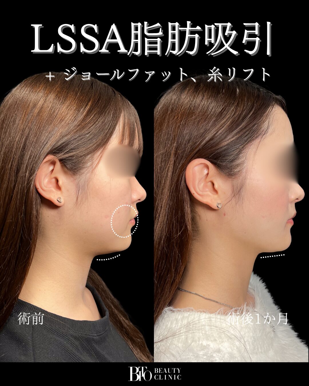 073.LSSA脂肪吸引