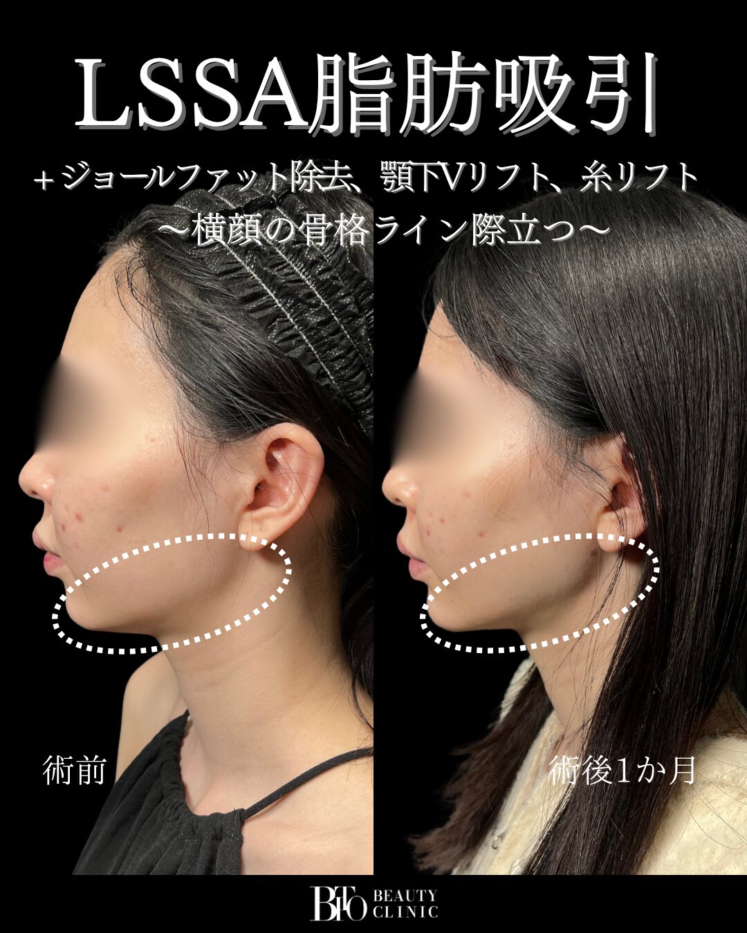 072.LSSA脂肪吸引