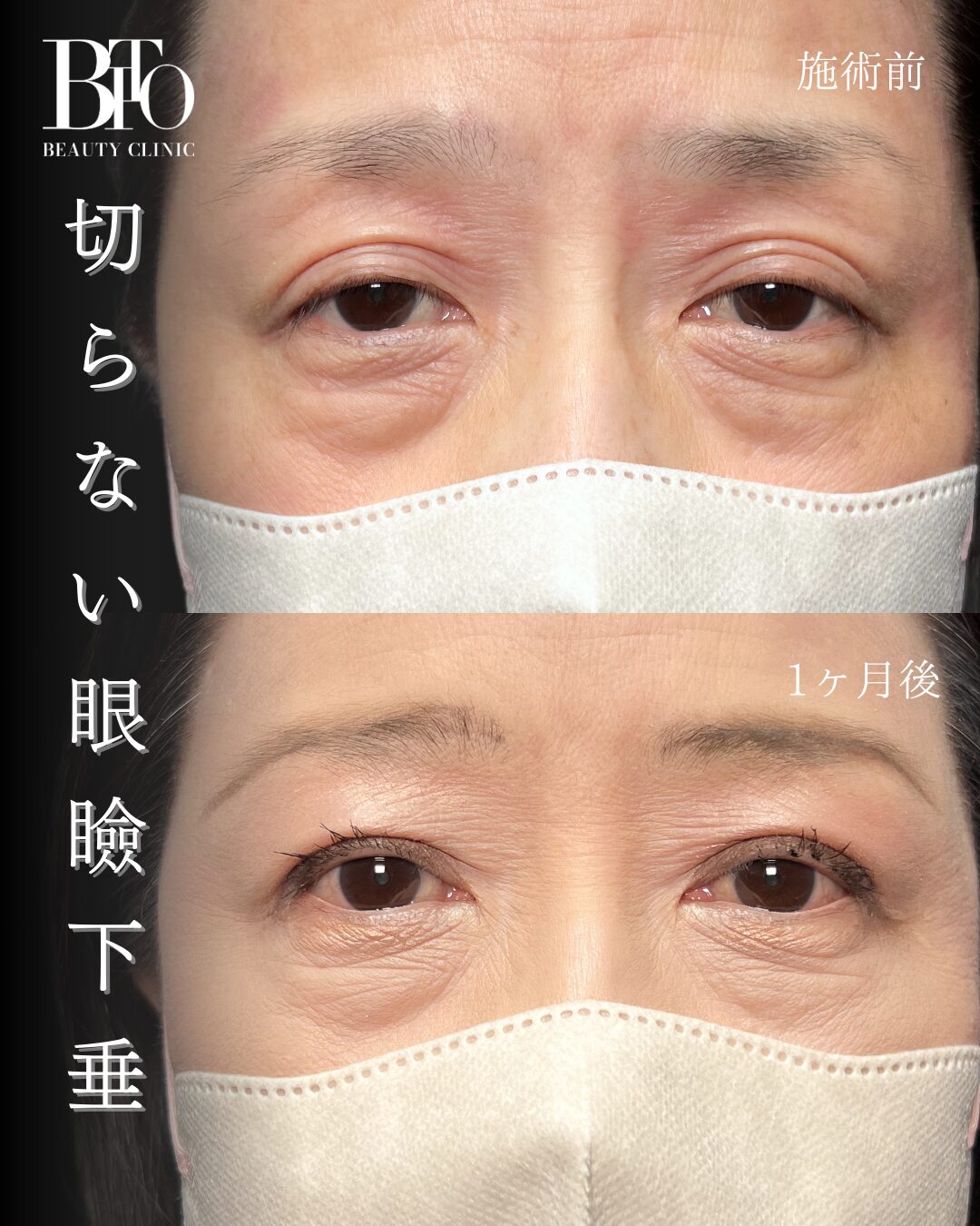 106.切らない眼瞼下垂