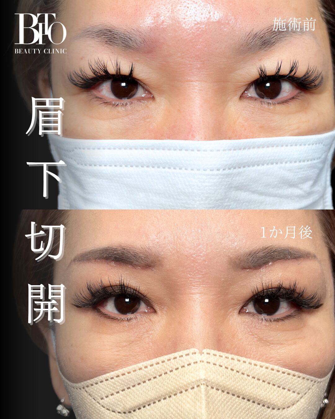 075.眉下リフト