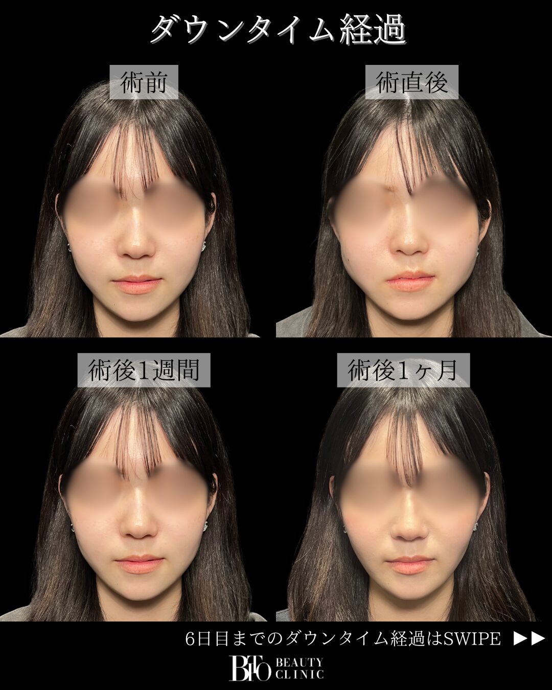 バッカルファット除去の症例