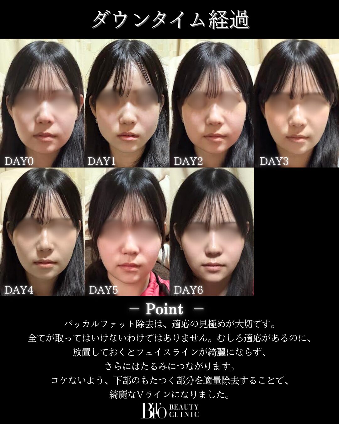 バッカルファット除去の症例