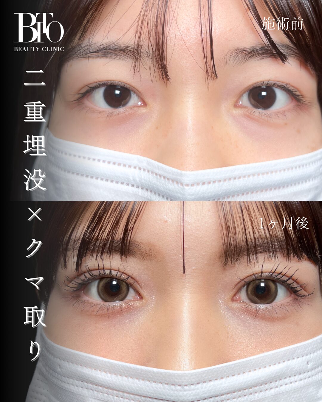 110.二重埋没法・切らないクマ取り（脱脂術）