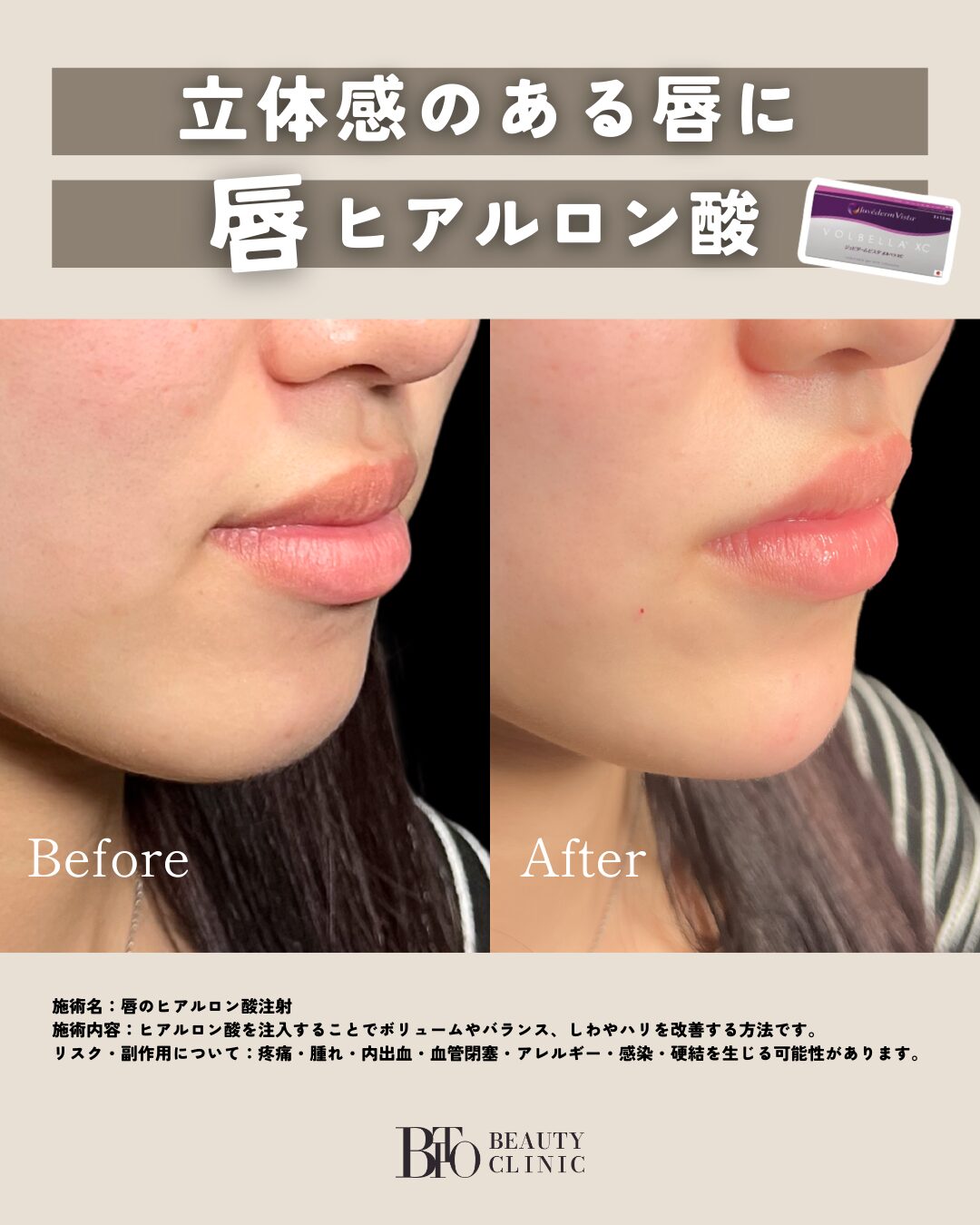 117.ヒアルロン酸注入