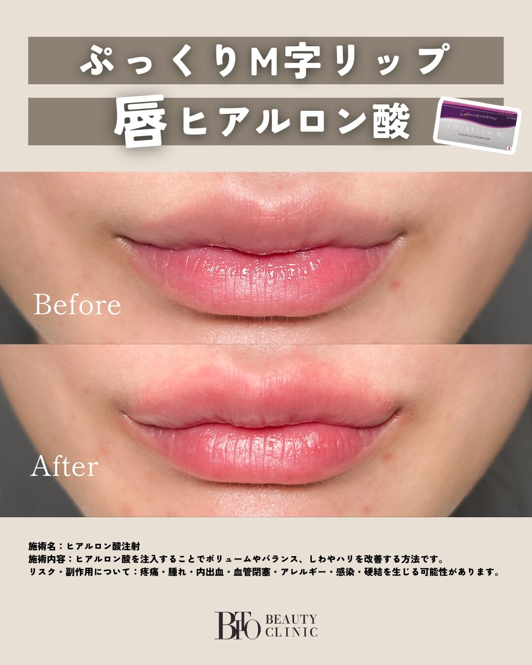 116.ヒアルロン酸注入