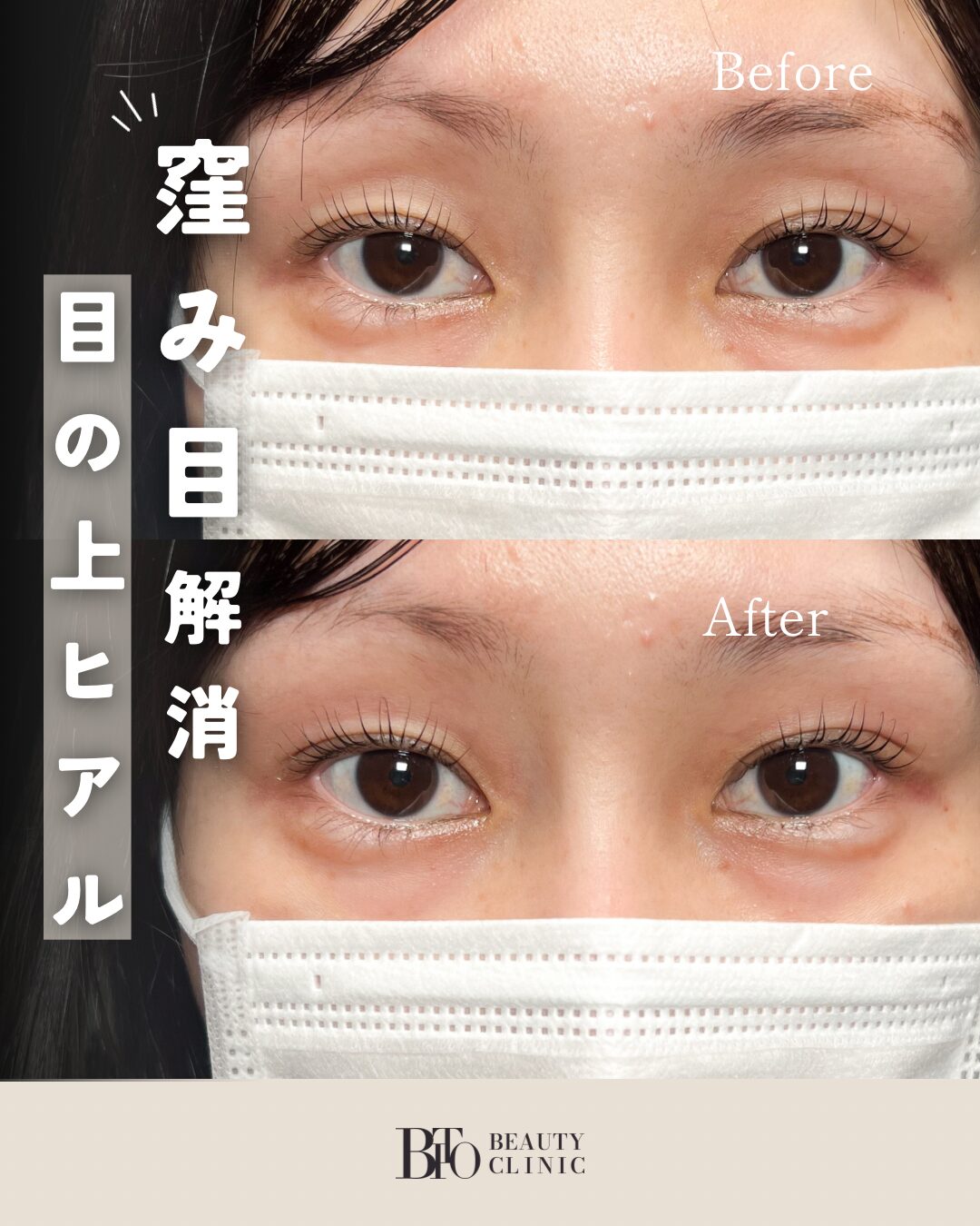 123.ヒアルロン酸注入