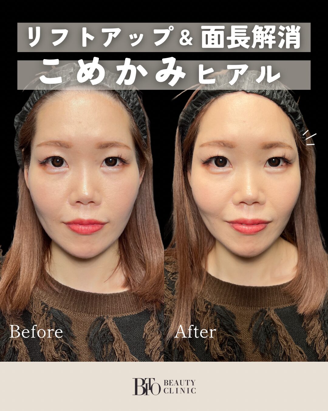 119.ヒアルロン酸注入