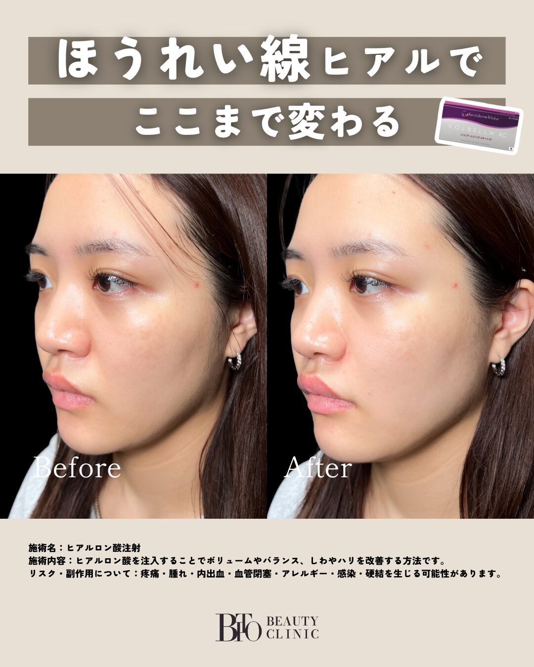 115.ヒアルロン酸注入