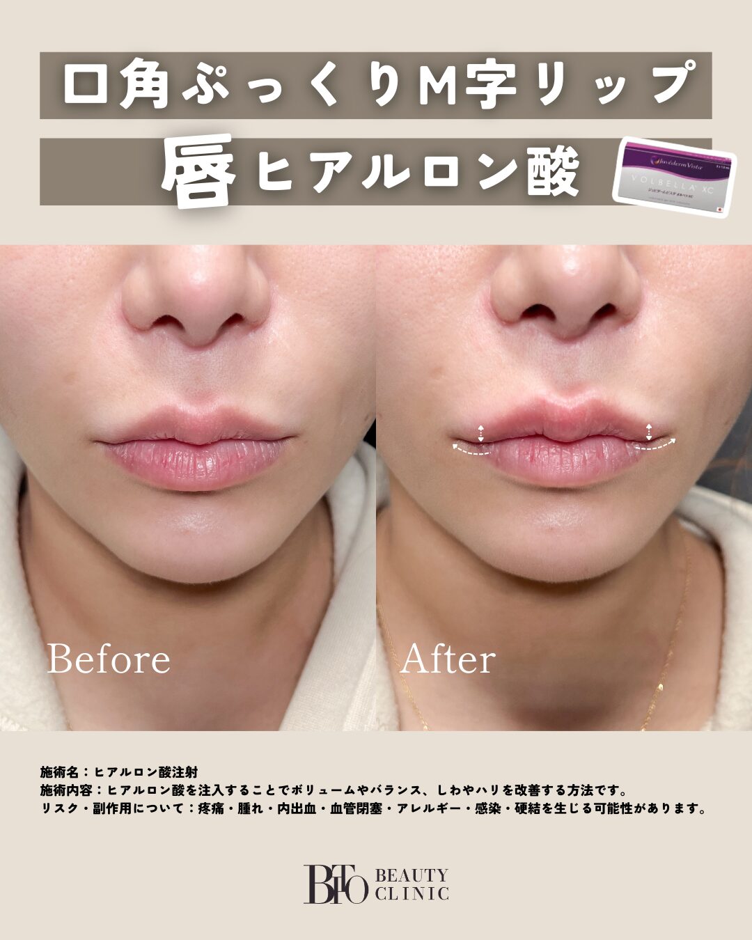 114.ヒアルロン酸注入