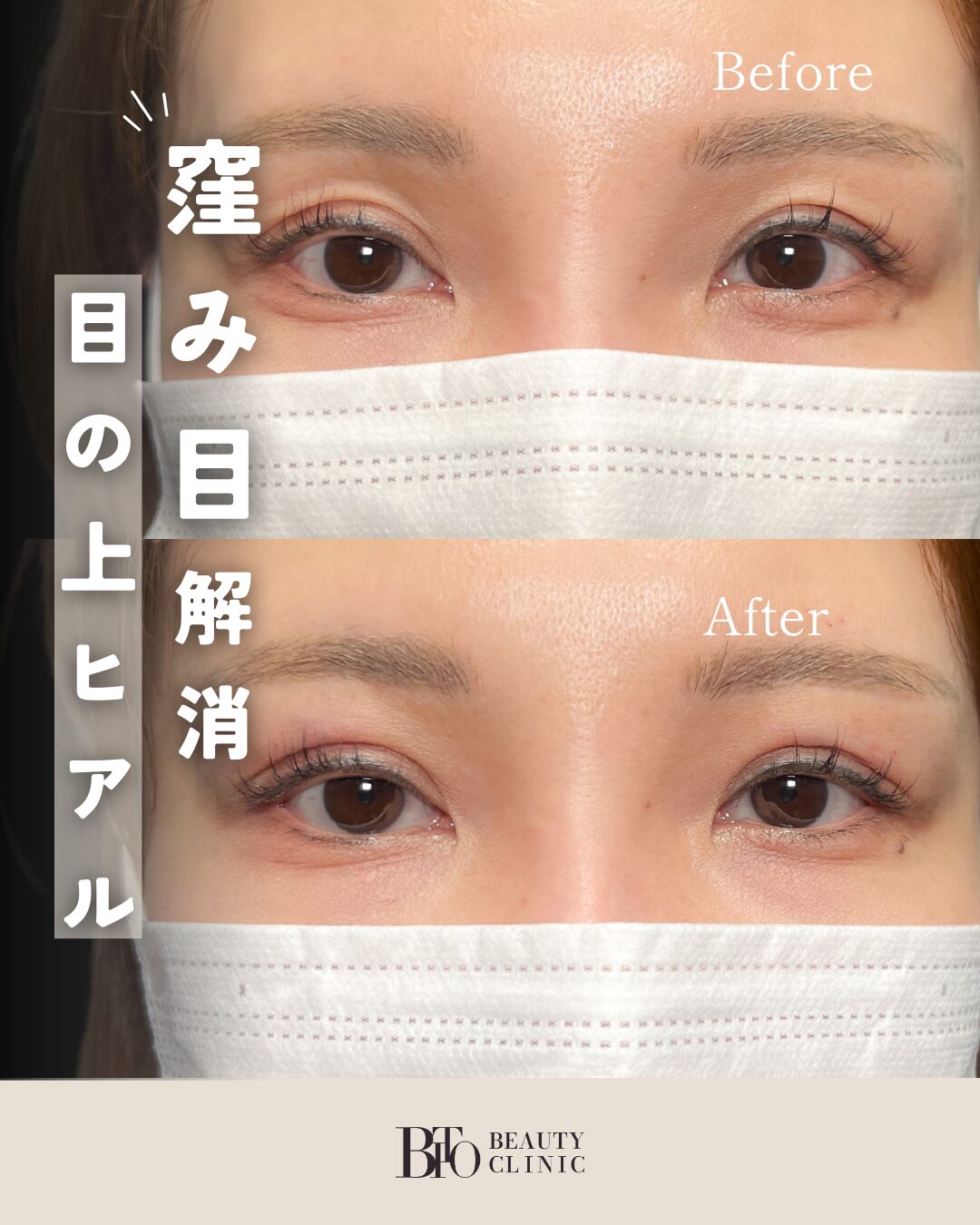 108.ヒアルロン酸注入(目の上)