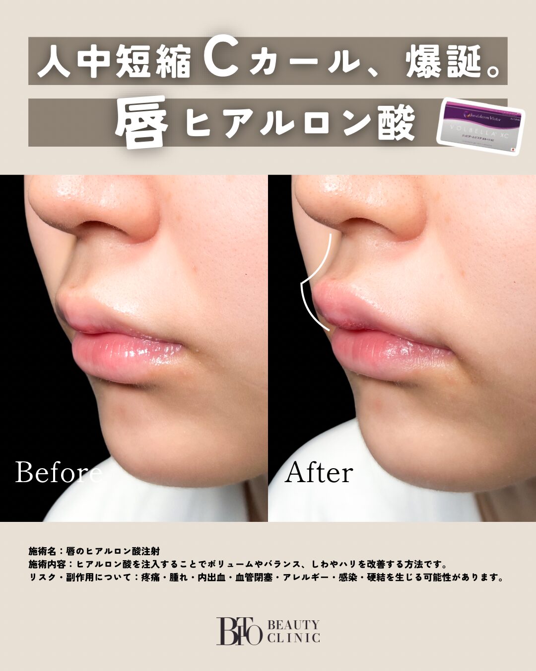 112.ヒアルロン酸注入