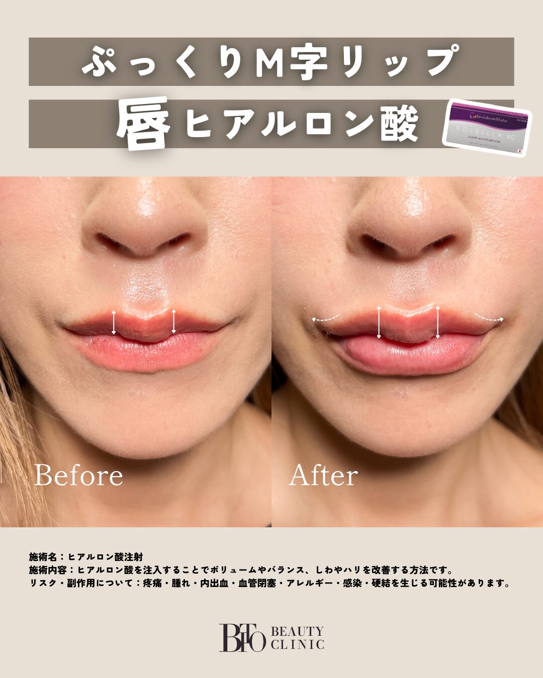 113.ヒアルロン酸注入