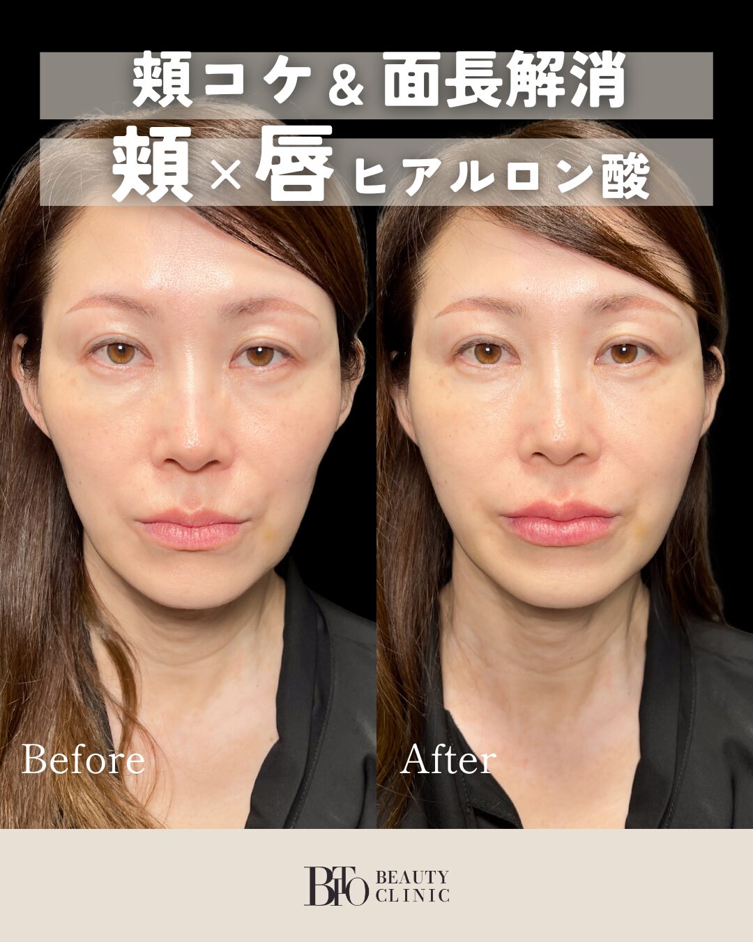 109.ヒアルロン酸注入(唇・頬)