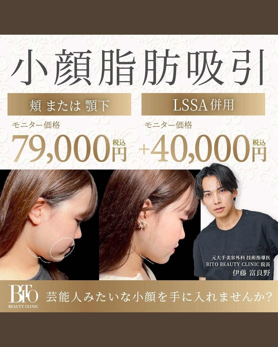 小顔脂肪吸引 ほほorあご下全体 ￥79,000- ※LSSA併用オプション使用時 別途40,000円(税込)