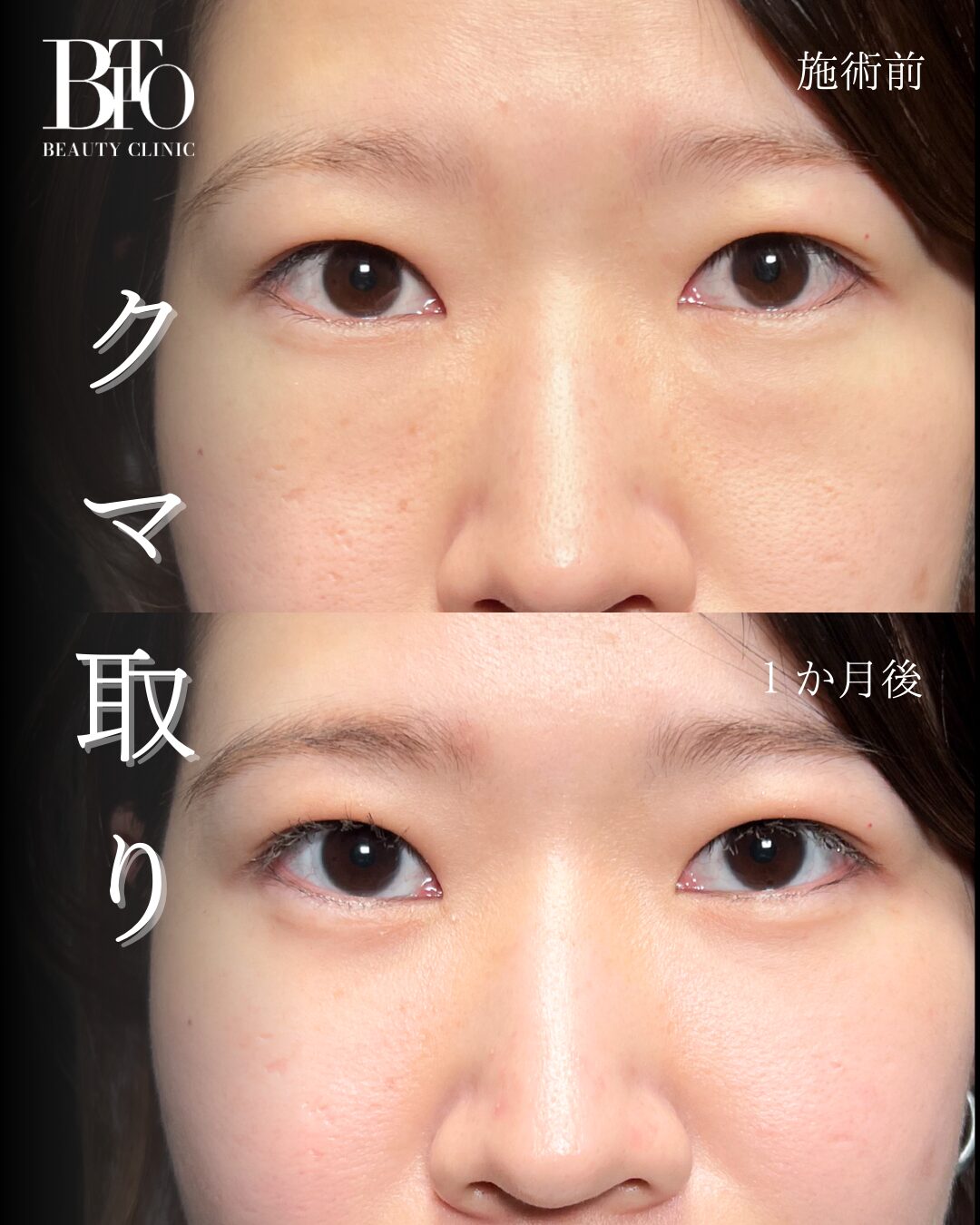 136.切らないクマ取り(脱脂術)