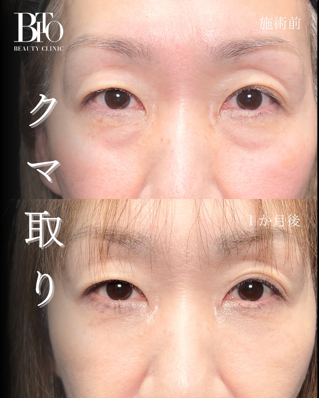 128.切らないクマ取り(脱脂術)