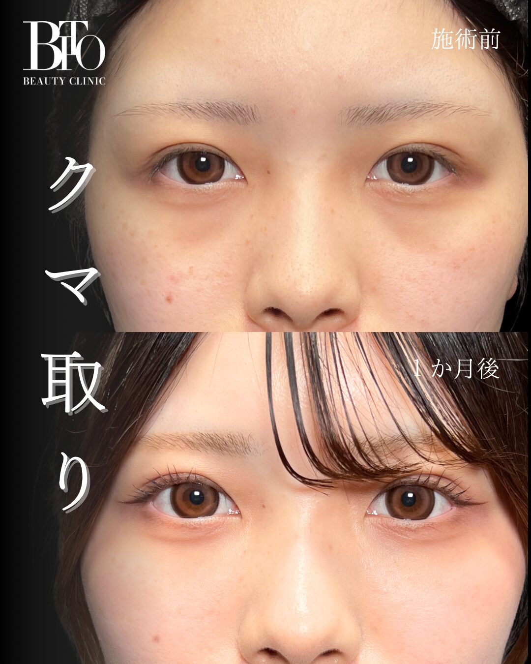 127.切らないクマ取り(脱脂術)