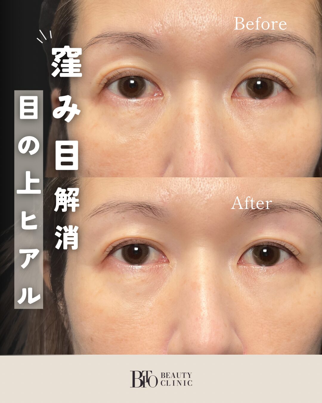 130.ヒアルロン酸注射