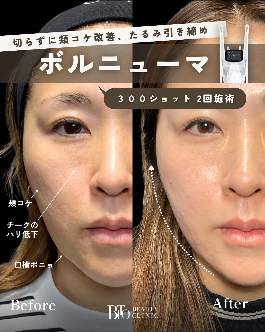 137.ボルニューマ