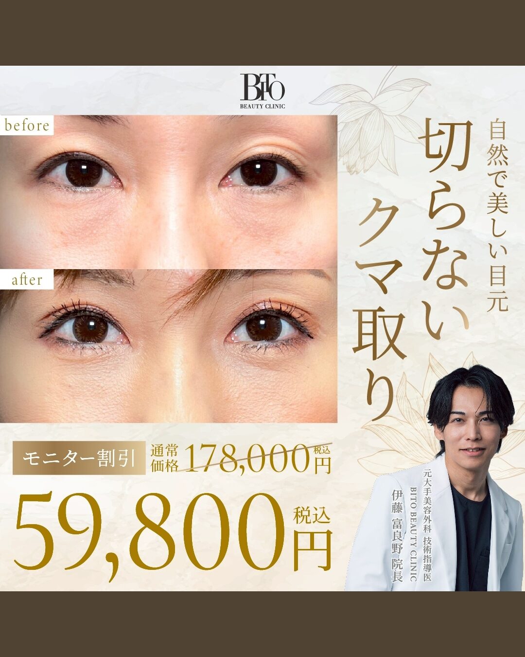 3月キャンペーン:切らないクマ取り(脱脂術) ￥178,000 → ￥59,800