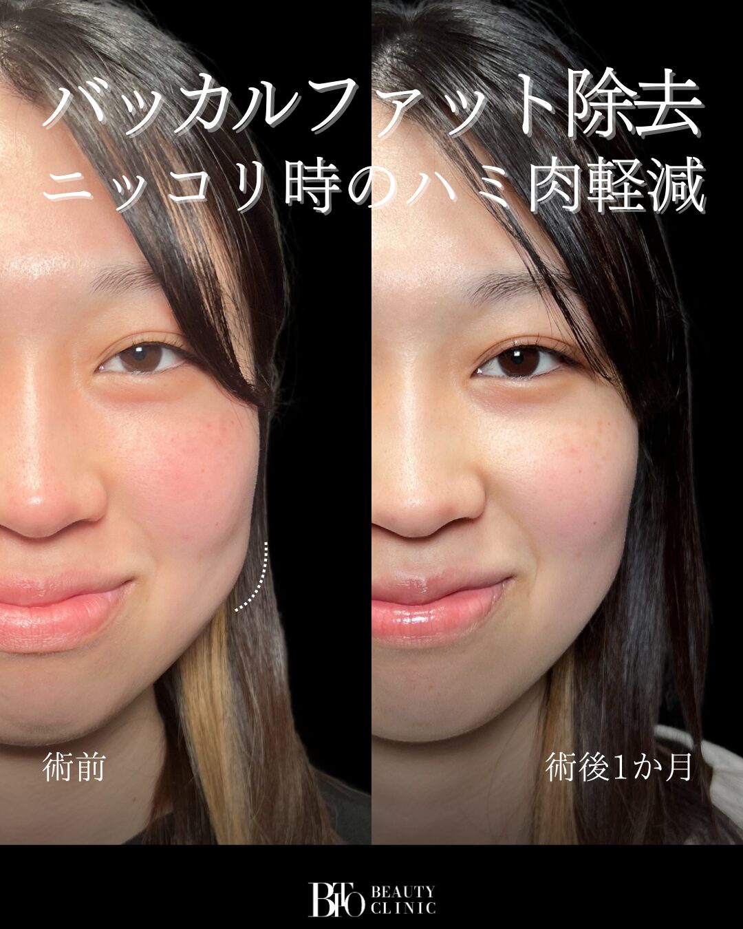 154.バッカルファット除去