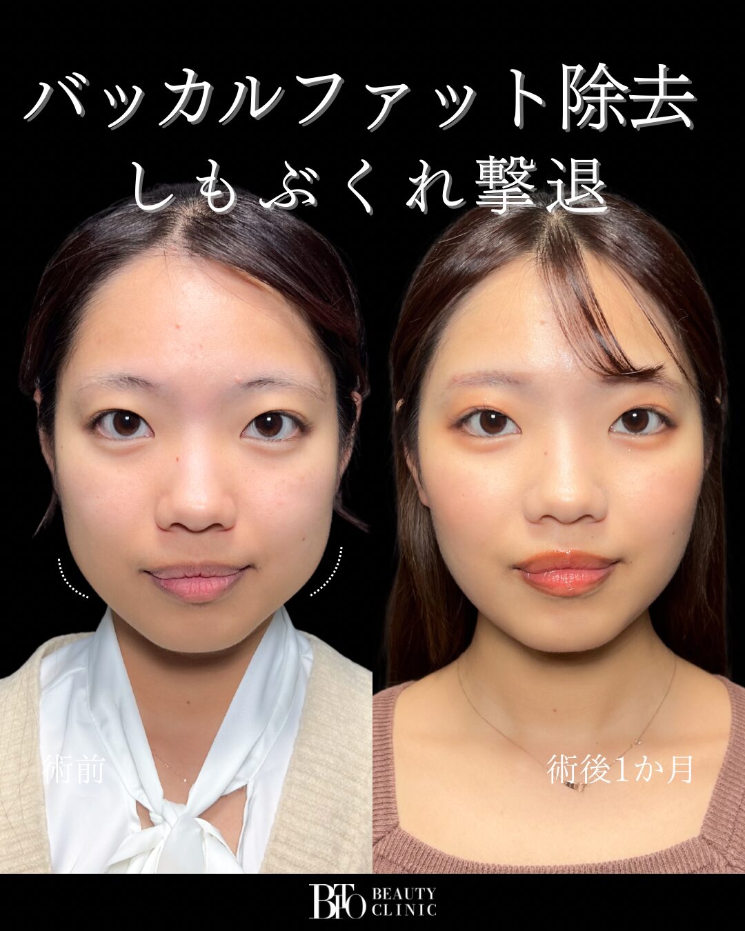 159.バッカルファット除去