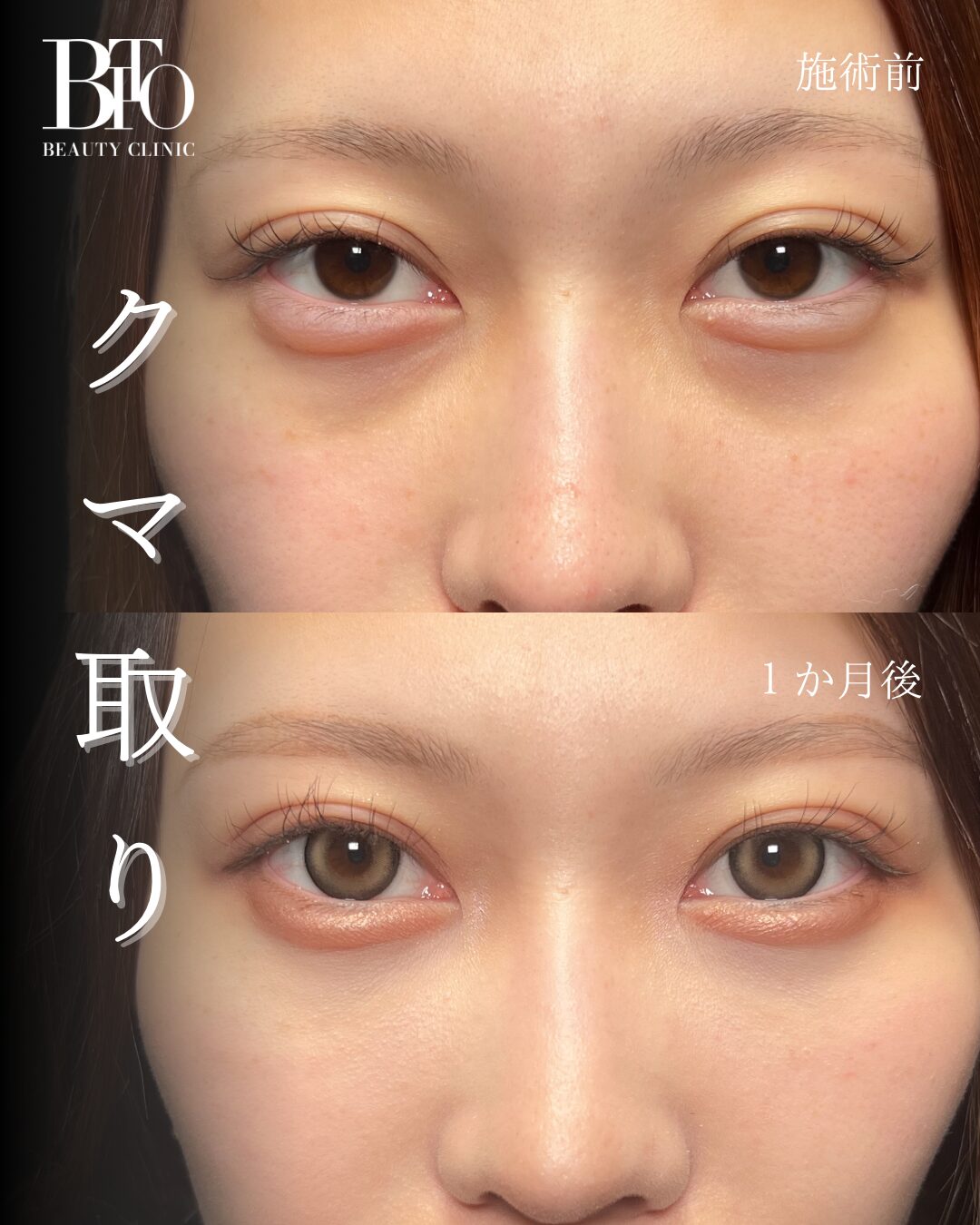 168.切らないクマ取り(脱脂術)