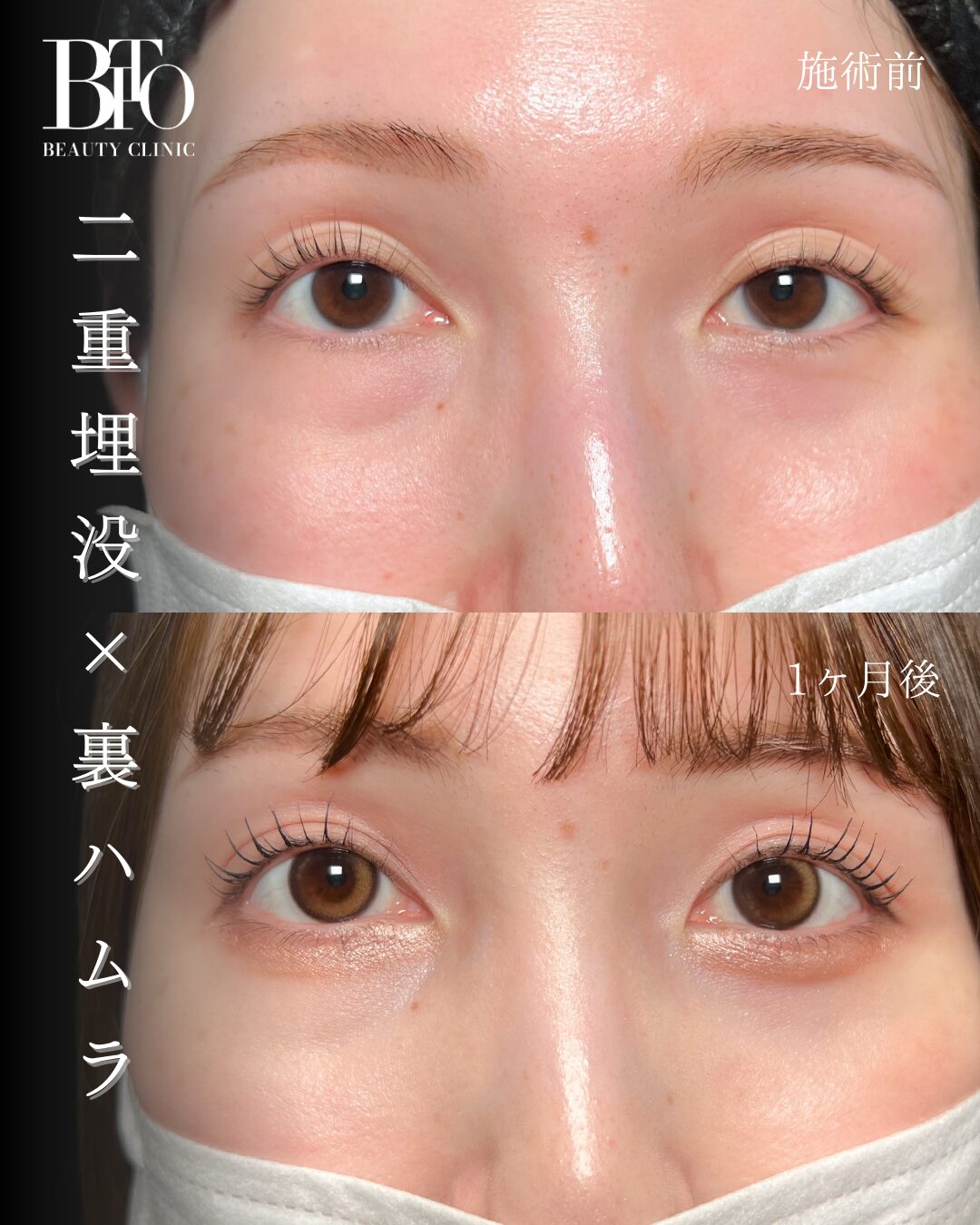 152.二重埋没・裏ハムラ