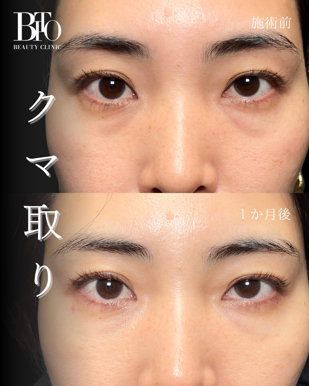 156.切らないクマ取り(脱脂術)